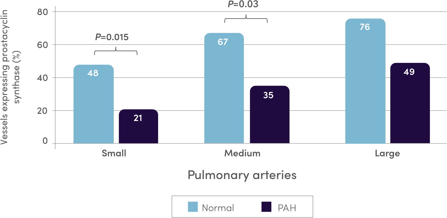 Chart showing the potential lack of prostacyclin in patients with PAH